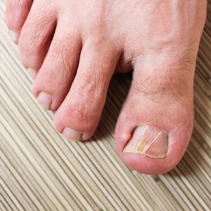 Ingrown Toenails Treatment  Foot Doctor North Andover, MA 01845