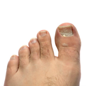 Ingrown Toenails Treatment  Foot Doctor North Andover, MA 01845